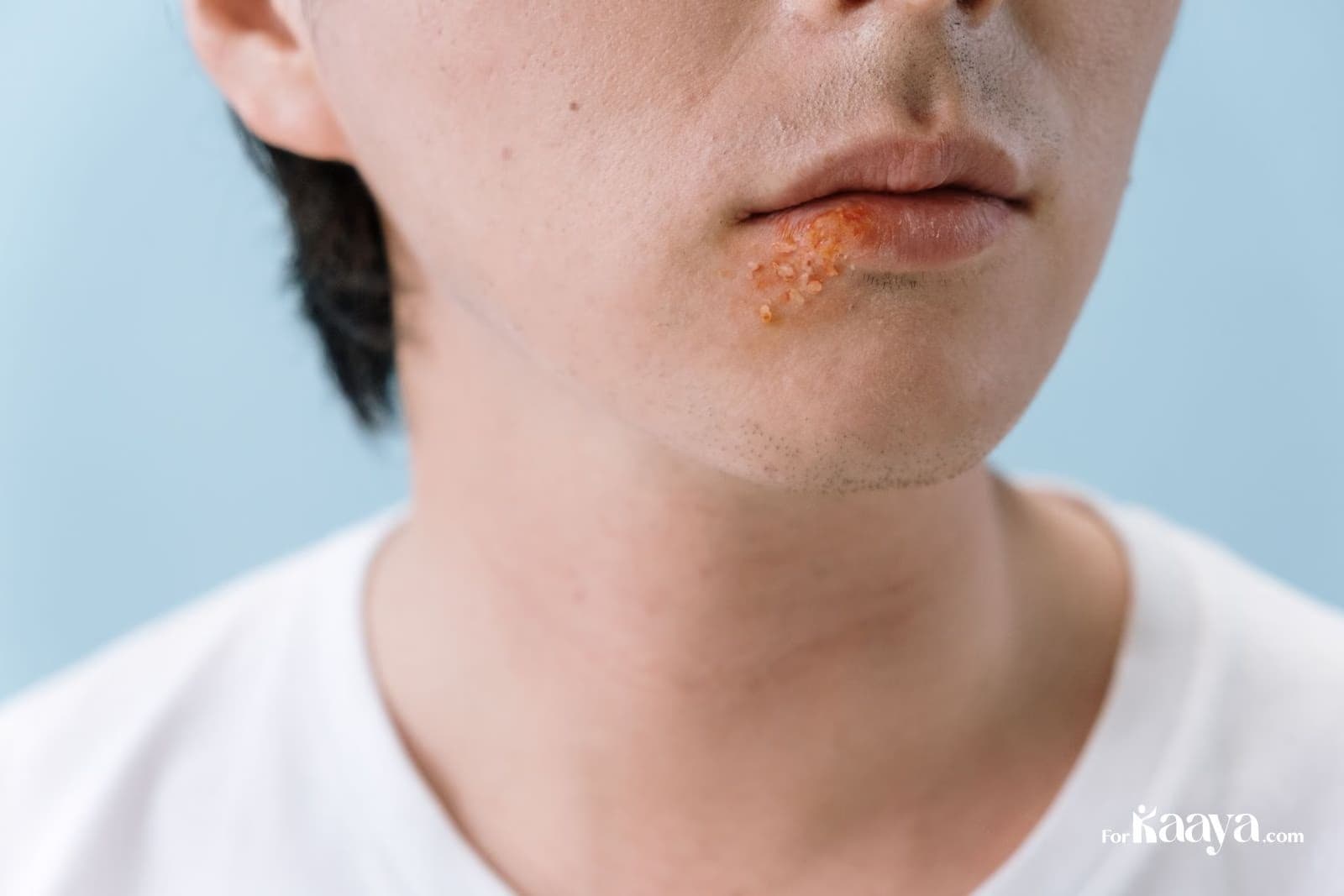 Best Ways To Get Rid Of Cold Sore Overnight